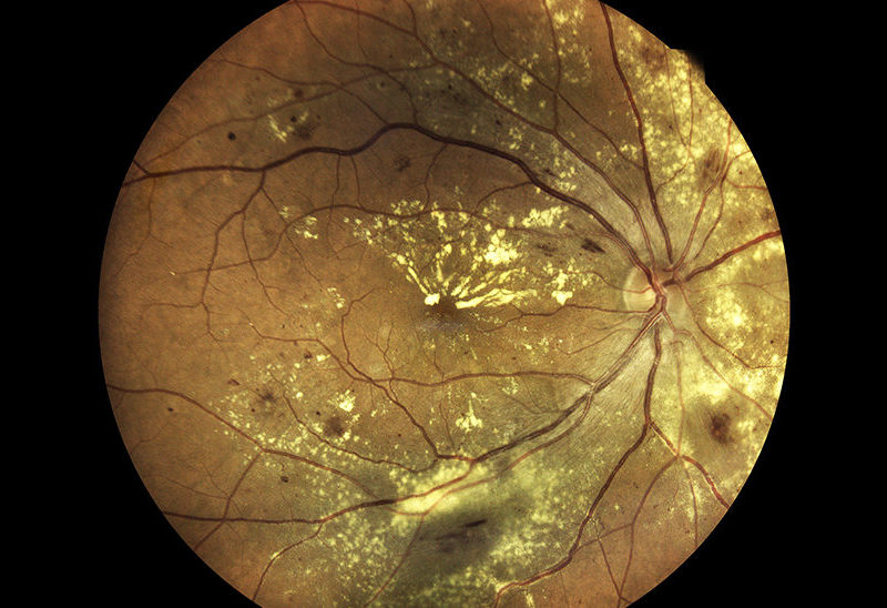 Age-related macular degeneration