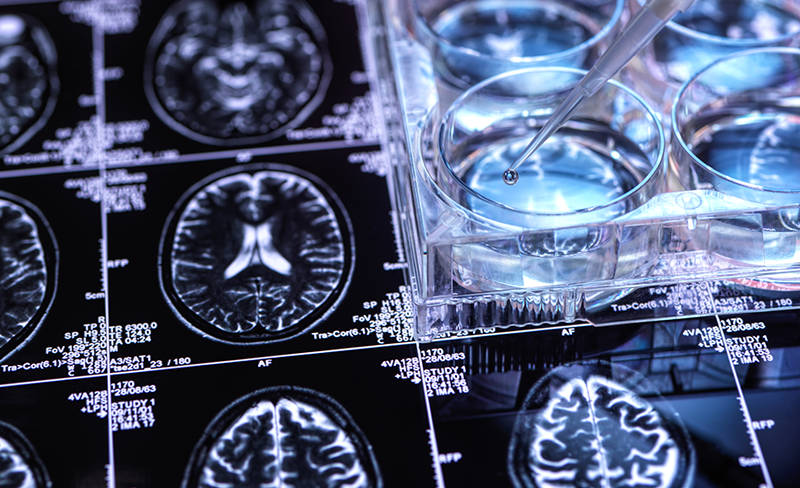 Cognitive decline