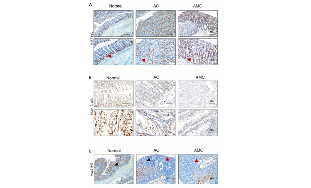 Colorectal cancer