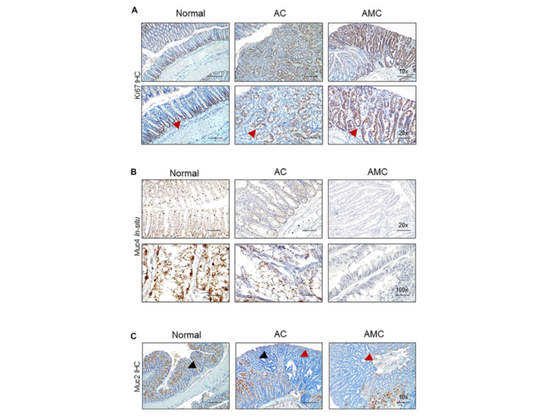 Colorectal cancer
