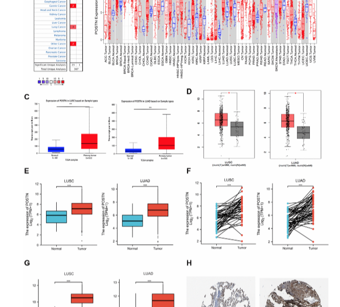 miRNAs-mediated overexpression of Periostin is correlated with poor prognosis and immune infiltration in lung squamous cell carcinoma