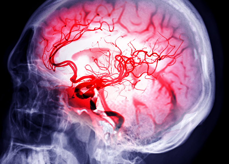 Stroke Outcomes Mediated by These 2 Mechanisms