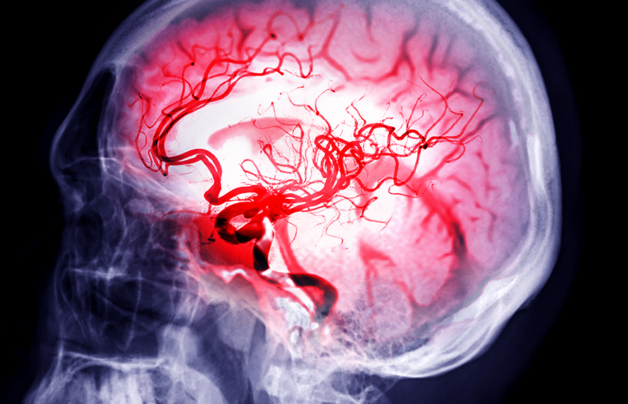 Stroke Outcomes Mediated by These 2 Mechanisms