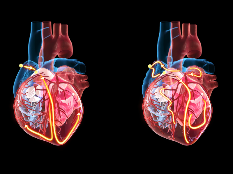 Navigating the Frailty Factor in Atrial Fibrillation Management